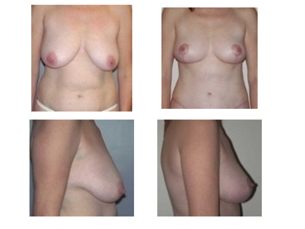 BREAST LIFT